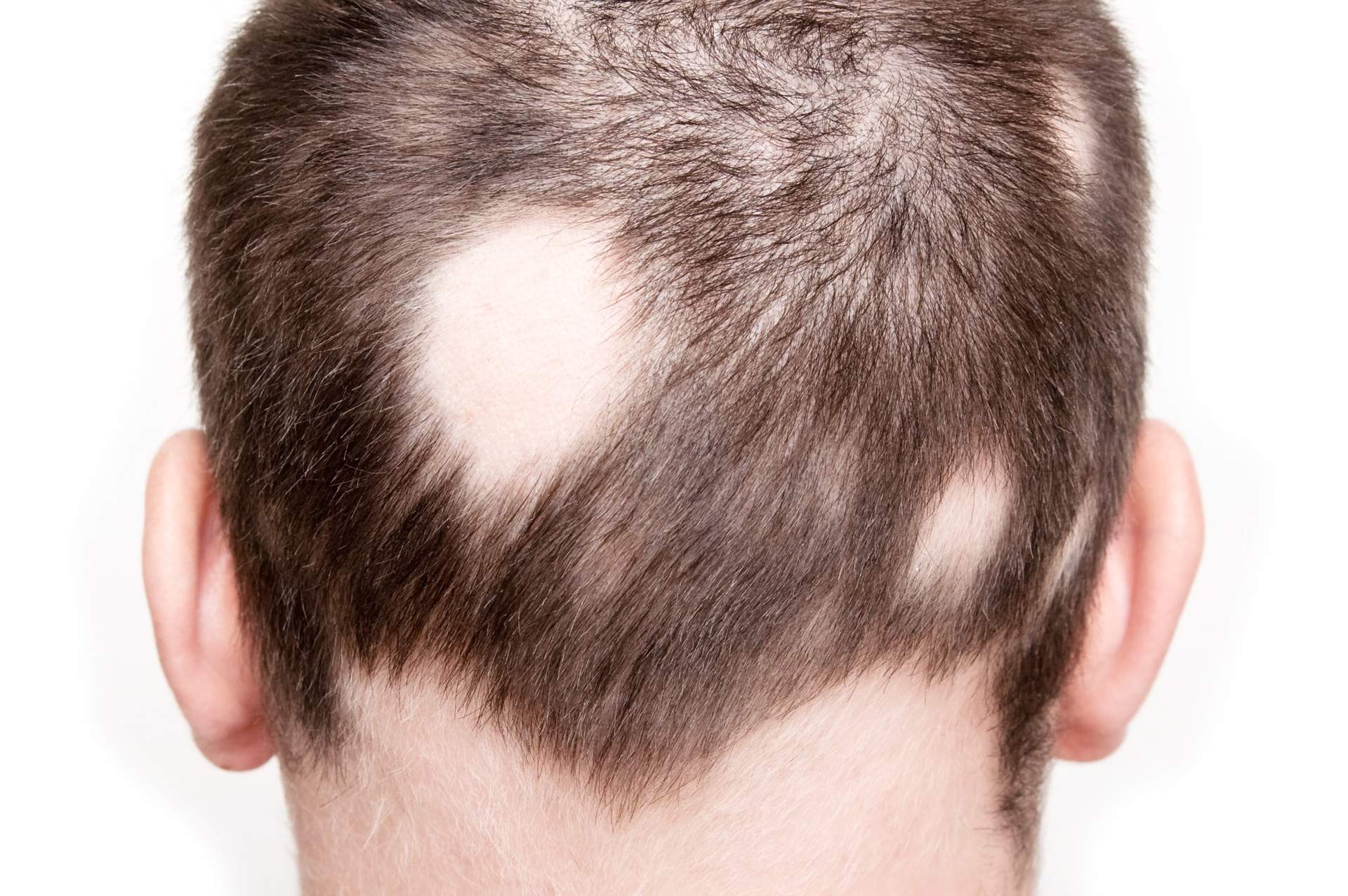 Волосы в виде восклицательного знака характерны для алопеции